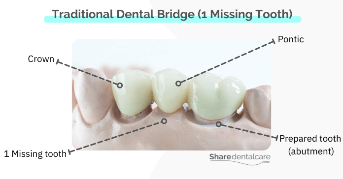A traditional bridge for a single missing lower Tooth