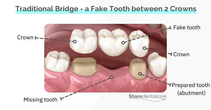 Traditional Dental Bridge - Fake Tooth is Supported from Both Sides