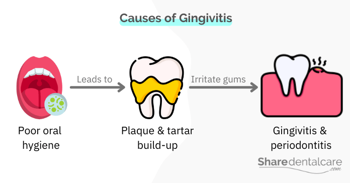 What is gingivitis caused by? poor oral hygiene & dental plaque
