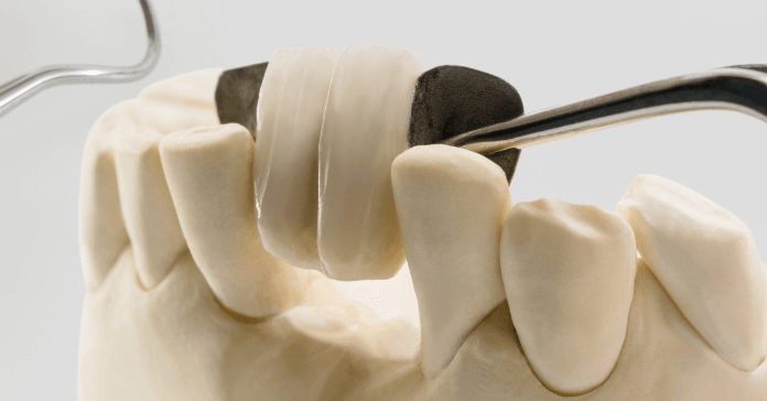 A Maryland bridge being placed onto a model with dental instruments.