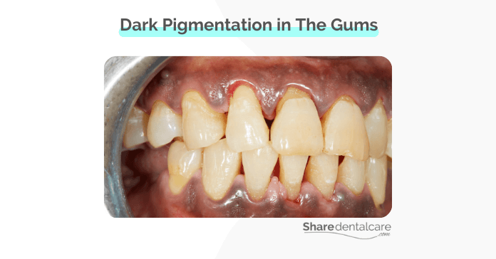 Dark pigmentation in the gums from smoking