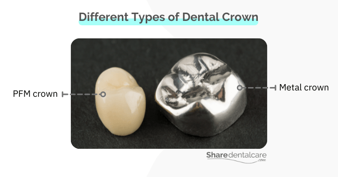 Different types of dental crown for a broken tooth