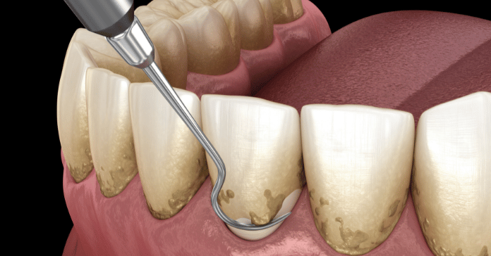 Scaling and root planing treatment for gum disease.