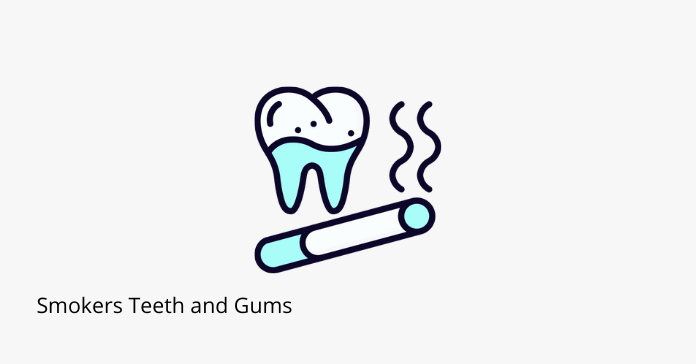 Smokers' Teeth and Gums: Effects of Smoking on Oral Health - Share ...
