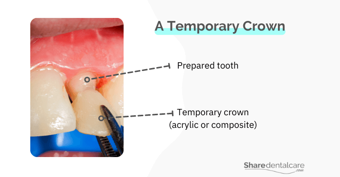 A temporary crowns