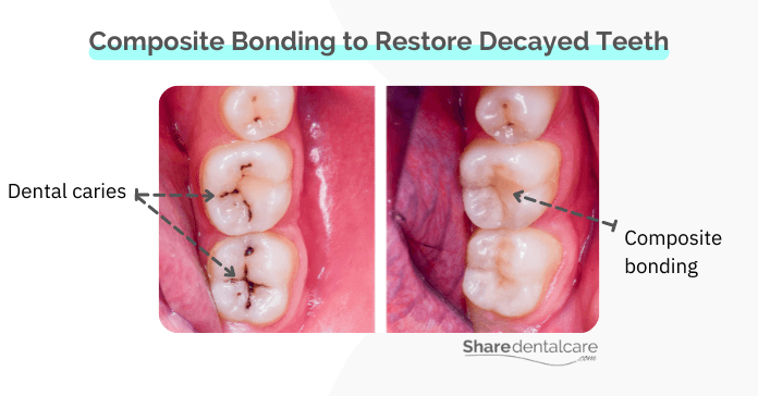 Composite bonding can restore a decayed tooth, but it can't replace a missing tooth
