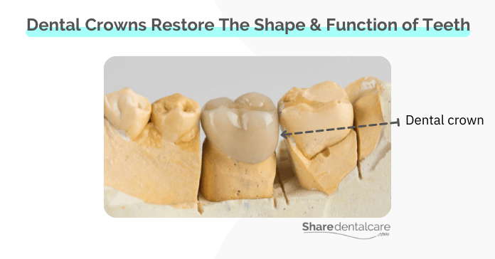Dental crowns can restore the shape and function of cracked teeth