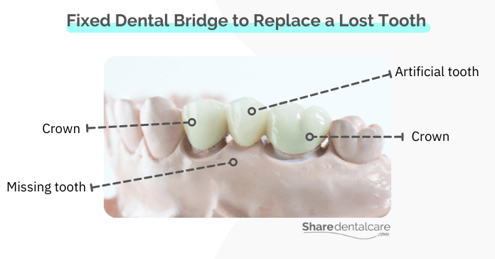 Fixed Dental Bridge to Replace a Lost Tooth 