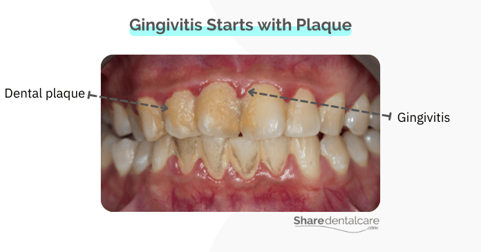 Gingivitis infection starts with dental plaque
