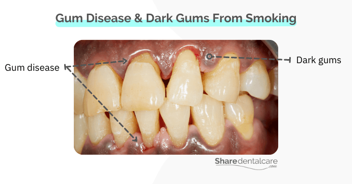 Gum disease and dark gums from smoking