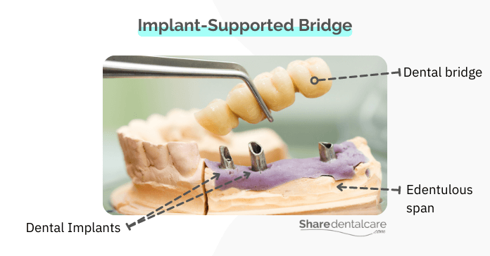 Dental implants for patients with no molars on one side of the mouth