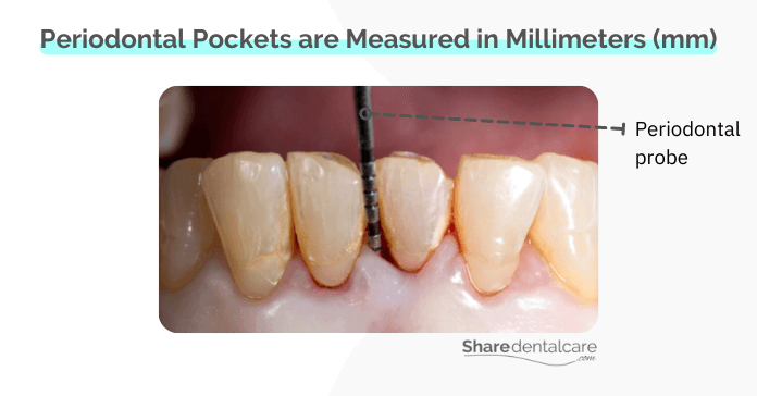 Measurement of deep periodontal pockets between teeth