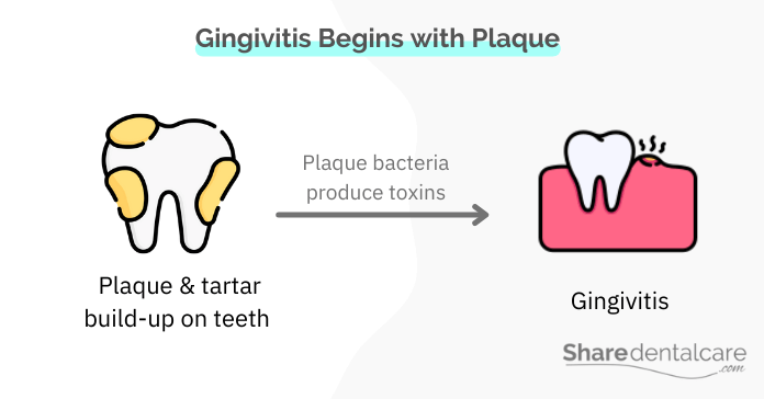If you have plaque, yo can get gingivitis