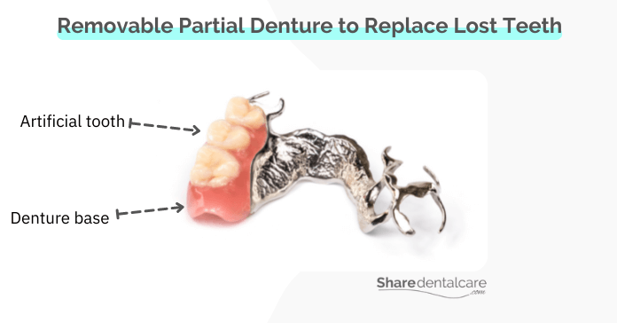 Removable Partial Denture to Replace Lost Teeth