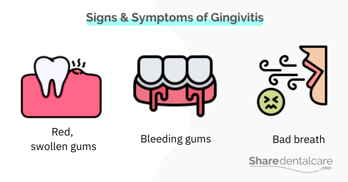 Signs and symptoms of gingivitis