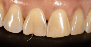 Crown on Cracked Tooth: How to Restore Broken Tooth Structure? - Share ...