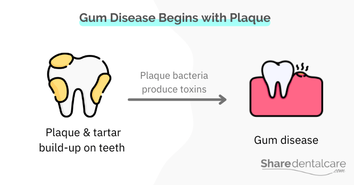 Plaque buildup causes gum disease (gingivitis and periodontitis)