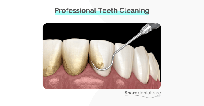 Professional teeth cleaning to treat gum infection. 