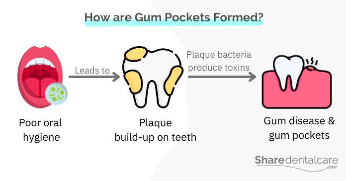How are Gum Pockets Formed?