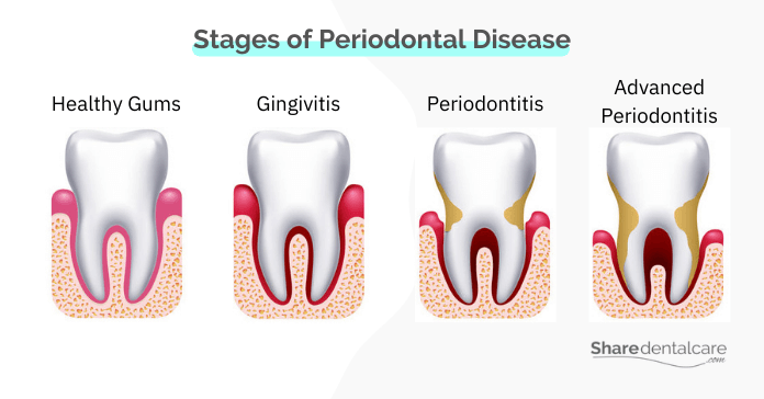 Stages of periodontal disease