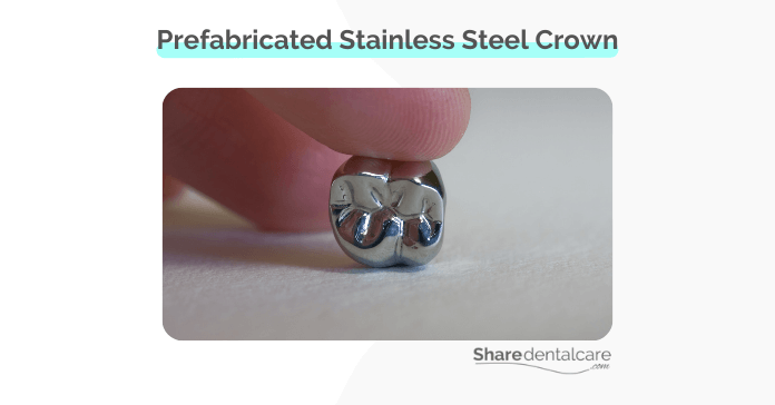 Prefabricated Stainless Steel Crown What You Need To Know Share Prefabricated Stainless Steel Crown What You Need To Know Share