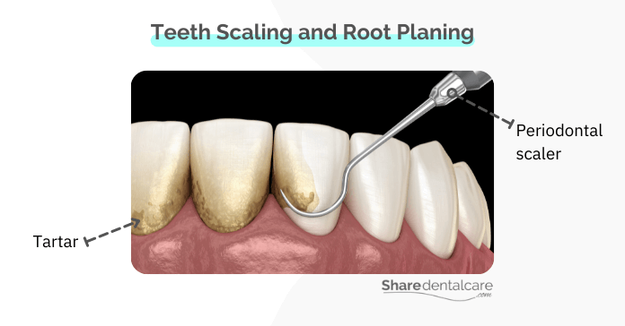 Scaling and root planing to treat infected gum pockets 