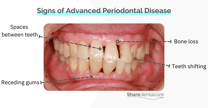 Signs of advanced periodontal disease include bone loss