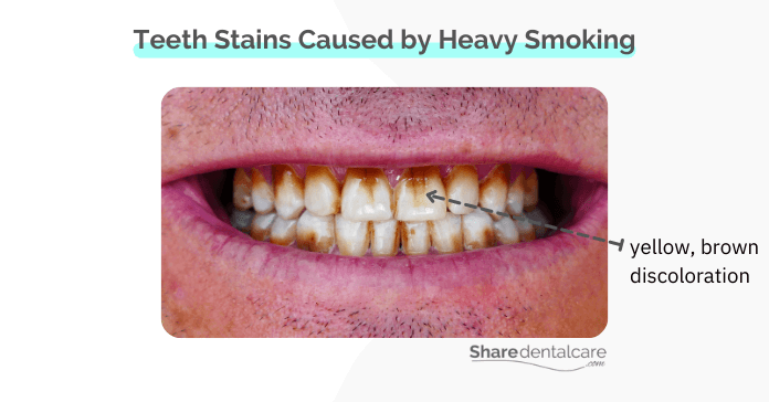 Teeth stains caused by heavy smoking
