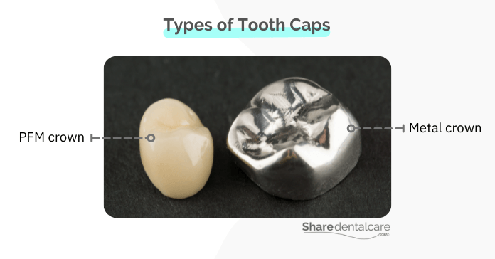 Types of tooth caps