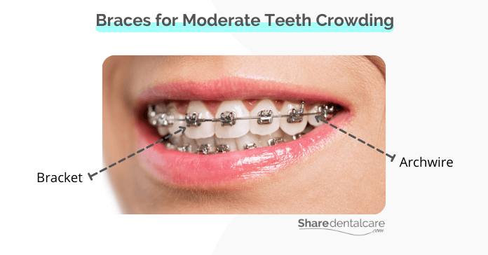 Braces for Moderate teeth crowding