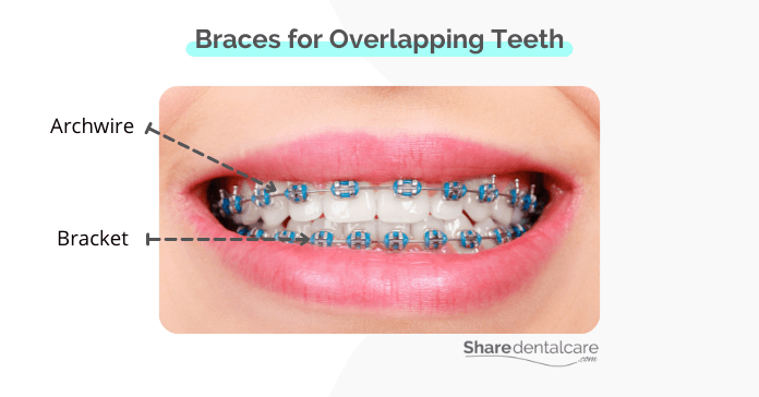 Braces are the most common treatment for overlapping teeth