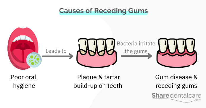 Causes of Receding Gums