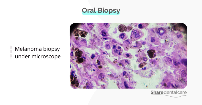 Oral biopsy