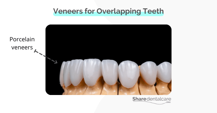 Porcelain veneers for overlapping teeth