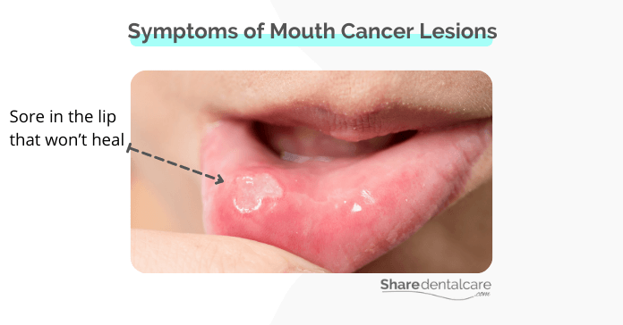 Symptoms of mouth cancer Lesions