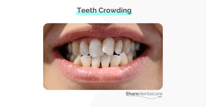 Teeth Crowding
