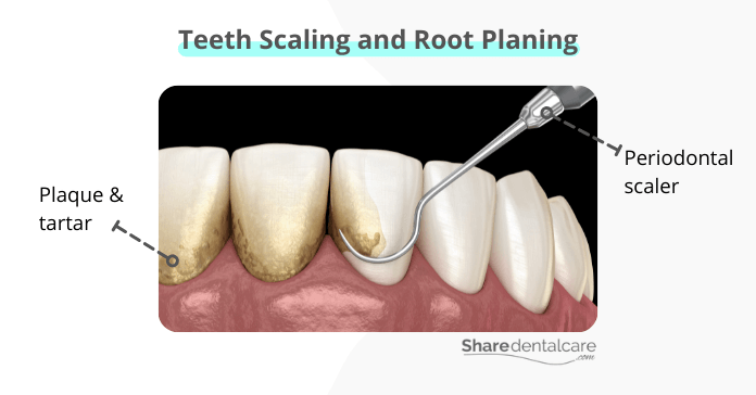 Teeth scaling and root planing