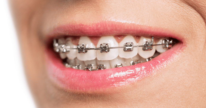 Close-up of smiling mouth with metal braces on upper and lower teeth for orthodontic treatment.