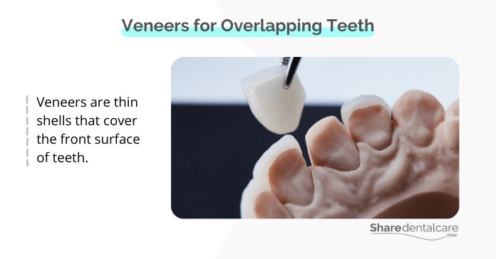 Veneers cover the front surface of teeth