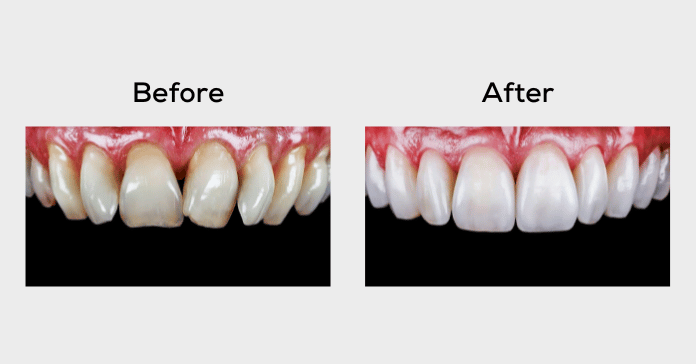 Before and after image showing correction of crowded teeth using ceramic veneers for improved alignment and appearance.