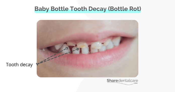 Baby bottle tooth decay (bottle rot)