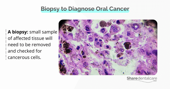Biopsy to diagnose oral cancer
