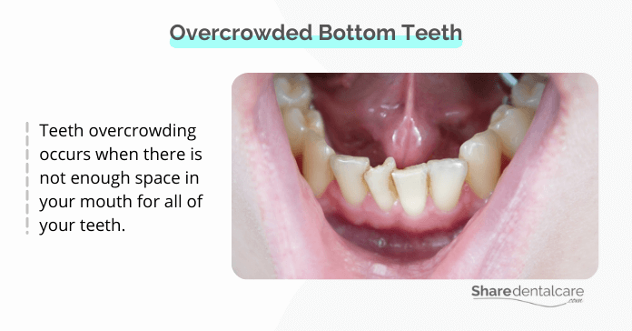 Bottom Teeth Overcrowded