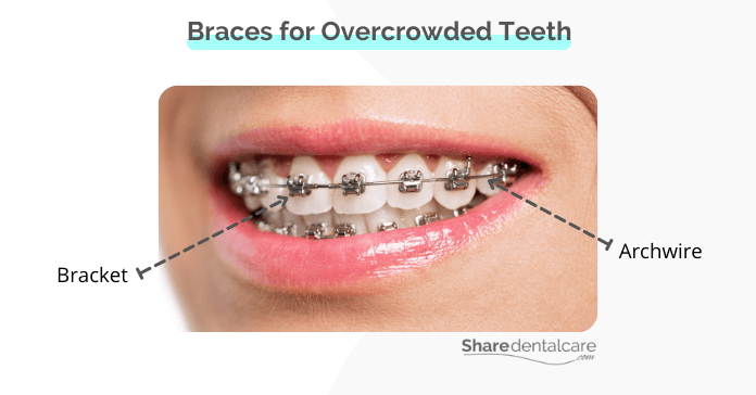 Braces for overcrowded bottom teeth