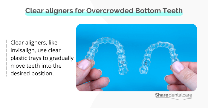 Clear aligners for overcrowded bottom teeth