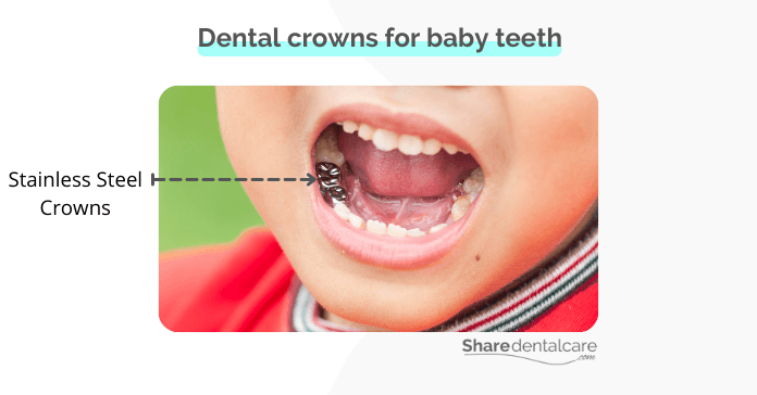 Dental crowns for baby teeth