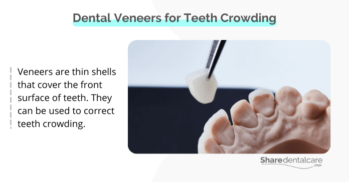 Dental veneers for crowding