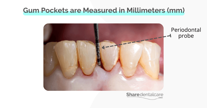 Periodontal pockets are measured in millimeters (mm)