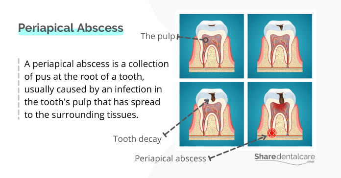 Periapical Abscess