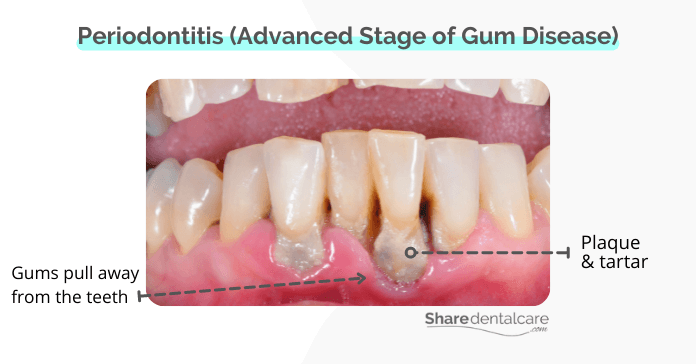 Periodontitis - an advanced stage of gum disease